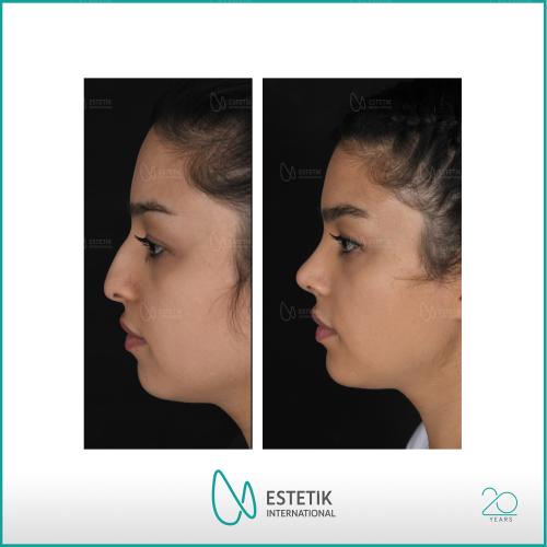 fotos antes y después de nuestros pacientes 7